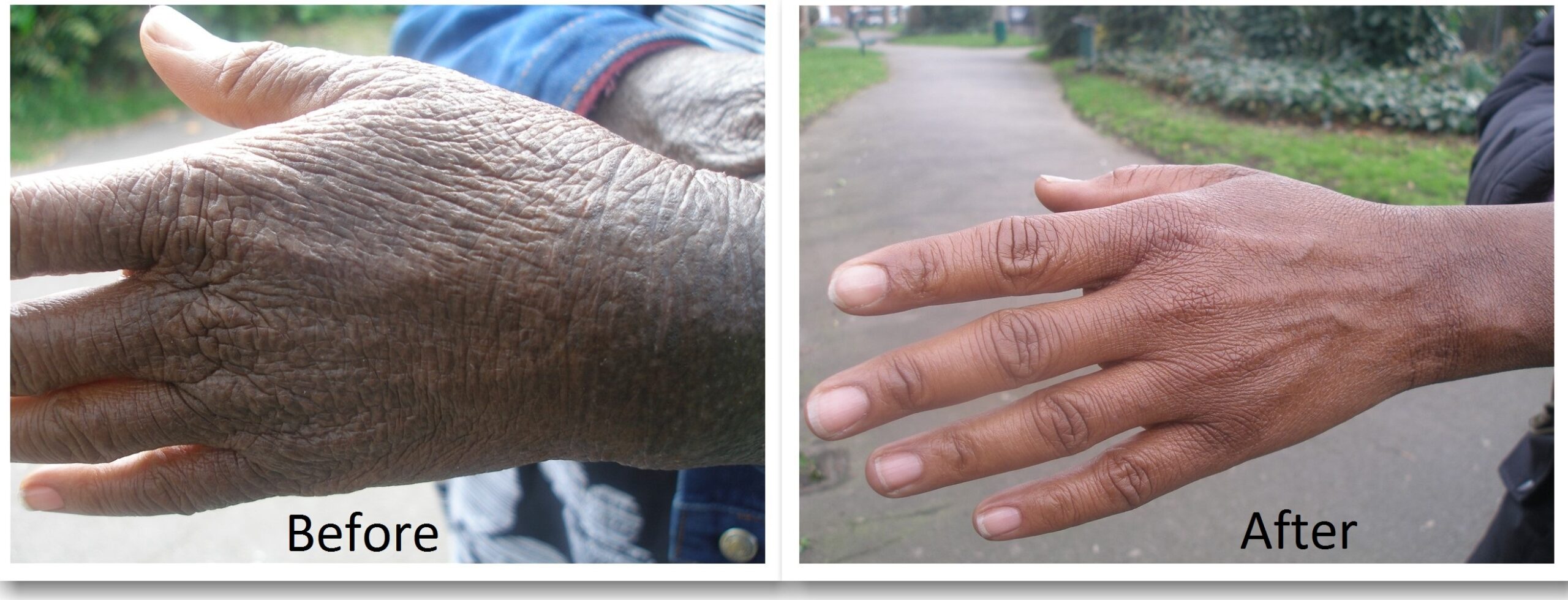 Carole Chambers - skin transformation with Emu Balm